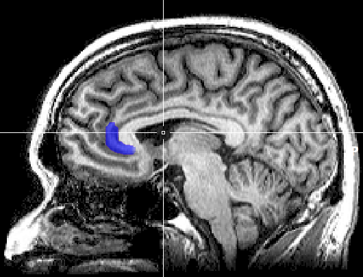 Image of scan showing sgACC  commons.wikimedia.org