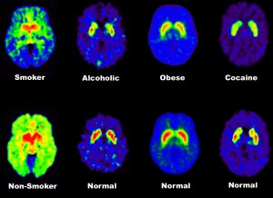                            Pet scans showing the difference in neural activity in addicted and non addicted brains
